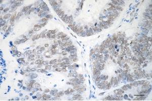 Immunohistochemistry was performed on paraffin-embedded human sigmoid colon carcinoma using EHMT2 antibody (ABIN7797609), 1:200).