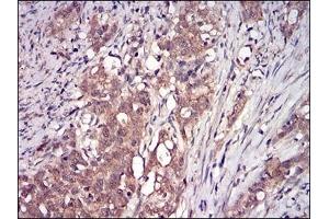 Immunohistochemical analysis of paraffin-embedded human cervical cancer tissues using DDIT3 mouse mAb with DAB staining. (DDIT3 antibody  (AA 87-192))