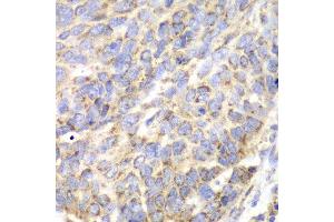 Immunohistochemistry of paraffin-embedded human esophageal cancer using ACY1 antibody at dilution of 1:100 (x40 lens).