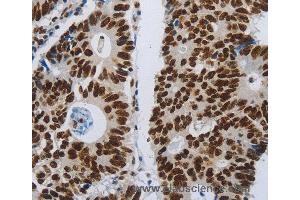 Immunohistochemistry of Human ovarian cancer using SLC16A14 Polyclonal Antibody at dilution of 1:80 (SLC16A14 antibody)