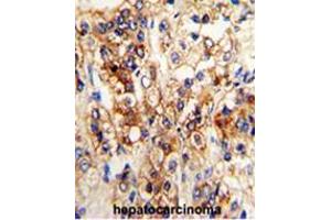 Formalin-fixed and paraffin-embedded human hepatocarcinoma reacted with CYP2J2 Antibody (N-term), which was peroxidase-conjugated to the secondary antibody, followed by DAB staining. (CYP2J2 antibody  (N-Term))