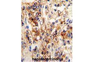 Formalin-fixed and paraffin-embedded human hepatocarcinoma reacted with CYP2J2 Antibody (N-term), which was peroxidase-conjugated to the secondary antibody, followed by DAB staining.