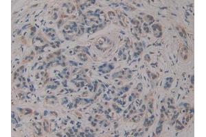 DAB staining on IHC-P; Samples: Human Pancreatic cancer Tissue (R-Spondin 3 antibody  (AA 22-272))