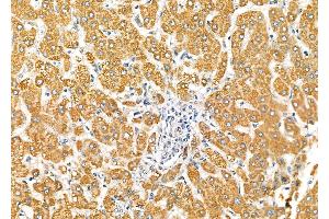 ABIN6264955 and ABIN6277302 at 1/100 staining Human liver cancer and adjacent normal tissues by IHC-P.