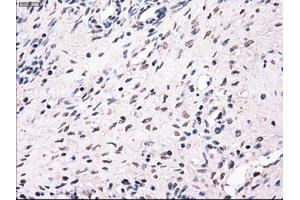 Immunohistochemical staining of paraffin-embedded Adenocarcinoma of breast tissue using anti-MRI1 mouse monoclonal antibody. (MRI1 antibody)