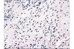 Immunohistochemical staining of paraffin-embedded Adenocarcinoma of breast tissue using anti-MRI1 mouse monoclonal antibody. (MRI1 antibody)
