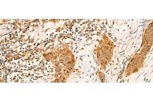Immunohistochemistry of paraffin-embedded Human esophagus cancer tissue using GINS2 Polyclonal Antibody at dilution of 1:50(x200)