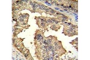 IHC testing of PRMT4 antibody and FFPE human prostate carcinoma. (CARM1 antibody  (AA 346-377))