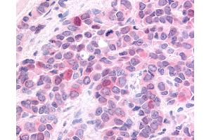 Anti-HUNK / B19 antibody IHC of human Breast, Carcinoma. (HUNK antibody  (Internal Region))