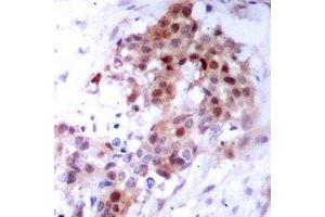 Immunohistochemical analysis of p38 staining in human breast cancer formalin fixed paraffin embedded tissue section. (MAPK14 antibody)