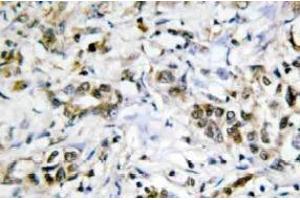Immunohistochemistry (IHC) analyzes of Galectin-4 antibody in paraffin-embedded human liver carcinoma tissue. (GAL4 antibody)