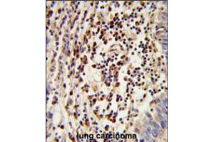Formalin-fixed and paraffin-embedded human lung carcinoma reacted with MOSC2 Antibody , which was peroxidase-conjugated to the secondary antibody, followed by DAB staining. (MARC2 antibody  (C-Term))