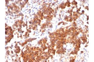 Formalin-fixed, paraffin-embedded human Parathyroid Mass stained with VEGI Mouse Recombinant Monoclonal Antibody (rVEGI /1283). (Recombinant TNFSF15 antibody)