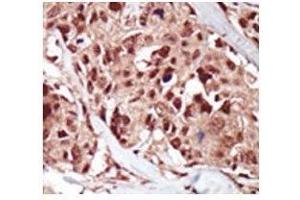 IHC analysis of FFPE human breast carcinoma tissue stained with the BRD4 antibody (BRD4 antibody  (AA 1-30))