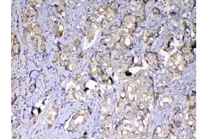 IHC analysis of MMP10 using anti-MMP10 antibody (A03759). (MMP10 antibody  (AA 239-476))