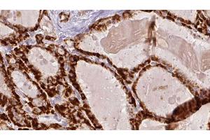 ABIN6267193 at 1/100 staining Human thyroid cancer tissue by IHC-P. (tau antibody  (pSer416))