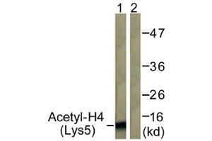 Immunohistochemistry analysis of paraffin-embedded human breast carcinoma tissue, using Histone H4 (Acetyl-Lys5) Antibody. (Histone H4 antibody  (acLys5))