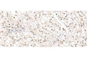 Immunohistochemistry of paraffin-embedded Human kidney cancer tissue using HENMT1 Polyclonal Antibody at dilution of 1:30(x200) (HENMT1 antibody)