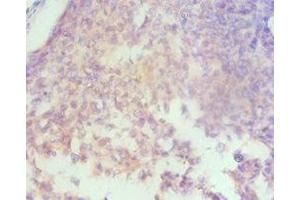 Immunohistochemistry of paraffin-embedded human cervical cancer using ABIN7155960 at dilution of 1:100 (HAS3 antibody  (AA 339-553))