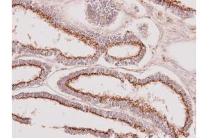 IHC-P Image Immunohistochemical analysis of paraffin-embedded human endometrial cancer, using GALNT7, antibody at 1:100 dilution. (GALNT7 antibody  (Center))