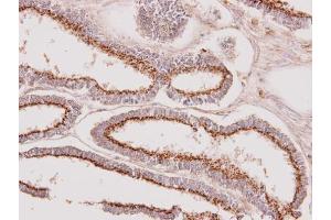 IHC-P Image Immunohistochemical analysis of paraffin-embedded human endometrial cancer, using GALNT7, antibody at 1:100 dilution.