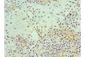 Immunohistochemistry of paraffin-embedded human breast cancer using ABIN7152153 at dilution of 1:100 (EIF3E antibody  (AA 1-445))