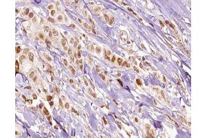 ABIN6266541 at 1/100 staining human breast carcinoma tissue sections by IHC-P. (FLI1 antibody  (Internal Region))