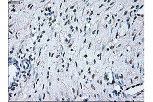 Immunohistochemical staining of paraffin-embedded Adenocarcinoma of colon tissue using anti-BRAFmouse monoclonal antibody. (BRAF antibody)