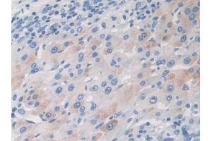 Detection of TARC in Mouse Liver cancer Tissue using Polyclonal Antibody to Thymus Activation Regulated Chemokine (TARC) (CCL17 antibody  (AA 12-83))