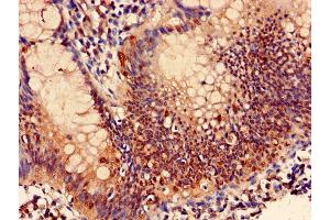 Immunohistochemistry of paraffin-embedded human colon cancer using ABIN7164986 at dilution of 1:100 (PSMB7 antibody  (AA 44-275))