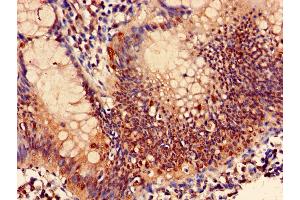 Immunohistochemistry of paraffin-embedded human colon cancer using ABIN7164986 at dilution of 1:100
