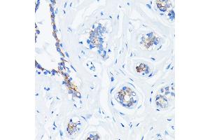 Immunohistochemistry of paraffin-embedded human breast cancer using HRAS antibody (ABIN7267785) at dilution of 1:100 (40x lens). (HRAS antibody)