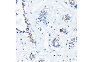Immunohistochemistry of paraffin-embedded human breast cancer using HRAS antibody (ABIN7267785) at dilution of 1:100 (40x lens). (HRAS antibody)