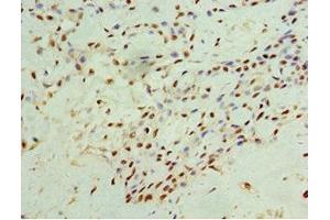 Immunohistochemistry of paraffin-embedded human breast cancer using ABIN7156601 at dilution of 1:100 (IFNGR1 antibody  (AA 270-489))