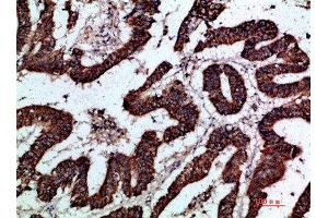 Immunohistochemical analysis of paraffin-embedded human-colon-cancer, antibody was diluted at 1:200 (GREM2 antibody  (AA 71-120))
