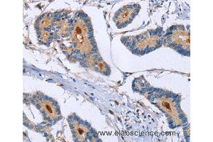 Immunohistochemistry of Human colon cancer using GMFG Polyclonal Antibody at dilution of 1:50