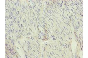 Immunohistochemistry of paraffin-embedded human bladder cancer using ABIN7166110 at dilution of 1:100 (SFI1 antibody  (AA 1003-1242))