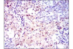 Immunohistochemical analysis of paraffin-embedded cervical cancer tissues using ASS1 mouse mAb with DAB staining. (ASS1 antibody)