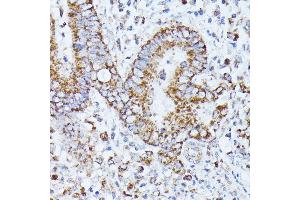 Immunohistochemistry of paraffin-embedded human colon carcinoma using PP2A Catalytic β antibody (ABIN3023492, ABIN3023493, ABIN3023494 and ABIN6220084) at dilution of 1:100 (40x lens). (PPP2CB antibody  (AA 1-309))