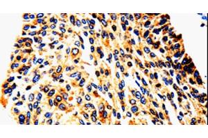 Immunohistochemistry of paraffin-embedded Human cervical cancer tissue using UTS2 Polyclonal Antibody at dilution 1:50 (Urotensin 2 antibody)