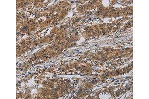 Immunohistochemistry of Human gastic cancer using INPPL1 Polyclonal Antibody at dilution of 1:40