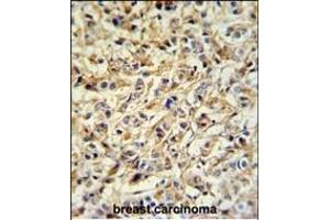 PRELP Antibody (Center) (ABIN652218 and ABIN2840925) IHC analysis in formalin fixed and paraffin embedded breast carcinoma followed by peroxidase conjugation of the secondary antibody and DAB staining. (PRELP antibody  (AA 119-148))