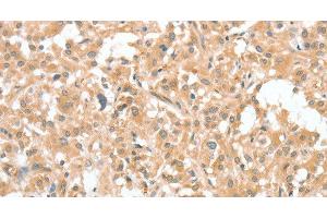 Immunohistochemistry of paraffin-embedded Human thyroid cancer using CIAPIN1 Polyclonal Antibody at dilution of 1:60 (CIAPIN1 antibody)