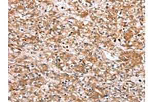 The image on the left is immunohistochemistry of paraffin-embedded Human prostate cancer tissue using ABIN7192440(SLC25A20 Antibody) at dilution 1/30, on the right is treated with synthetic peptide. (SLC25A2 antibody)