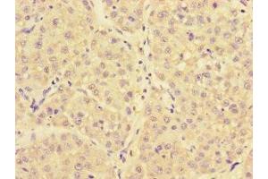 Immunohistochemistry of paraffin-embedded human liver cancer using ABIN7144725 at dilution of 1:100 (NARS antibody  (AA 1-300))