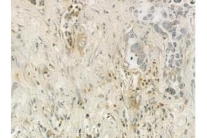 ABIN6257983 and ABIN6275857 at 1/100 staining human gastric carcinoma by IHC-P.