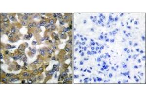Immunohistochemistry analysis of paraffin-embedded human breast carcinoma tissue, using Keratin 19 Antibody. (Cytokeratin 19 antibody  (AA 231-280))