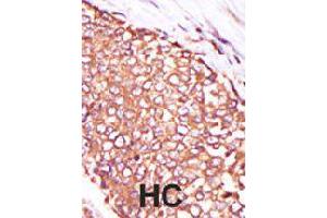 Formalin-fixed and paraffin-embedded human hepatocellular carcinoma tissue reacted with PRKCQ polyclonal antibody  , which was peroxidase-conjugated to the secondary antibody, followed by DAB staining . (PKC theta antibody  (C-Term))