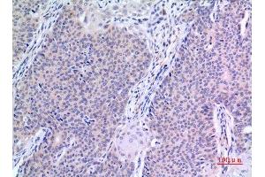 Immunohistochemistry (IHC) analysis of paraffin-embedded Human Mammary Cancer, antibody was diluted at 1:100. (VGF antibody  (Internal Region))