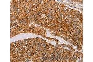 Immunohistochemistry of Human ovarian cancer using PRDX3 Polyclonal Antibody at dilution of 1:50 (Peroxiredoxin 3 antibody)